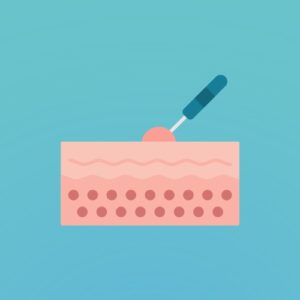 Warts Treatment Illustration of warts on skin being treated with a medical tool.